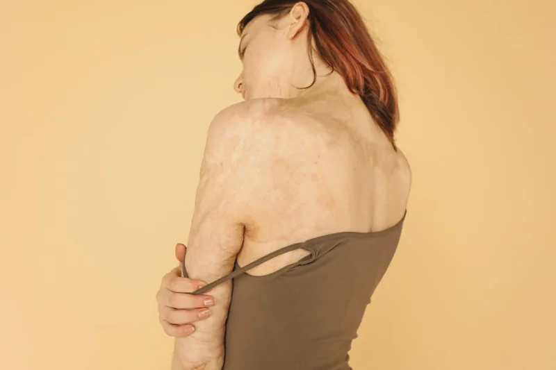 등드름 흉터 자연요법 홈케어